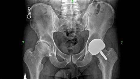 Direct Anterior Birmingham Hip Resurfacing: Surgical Techniq  .